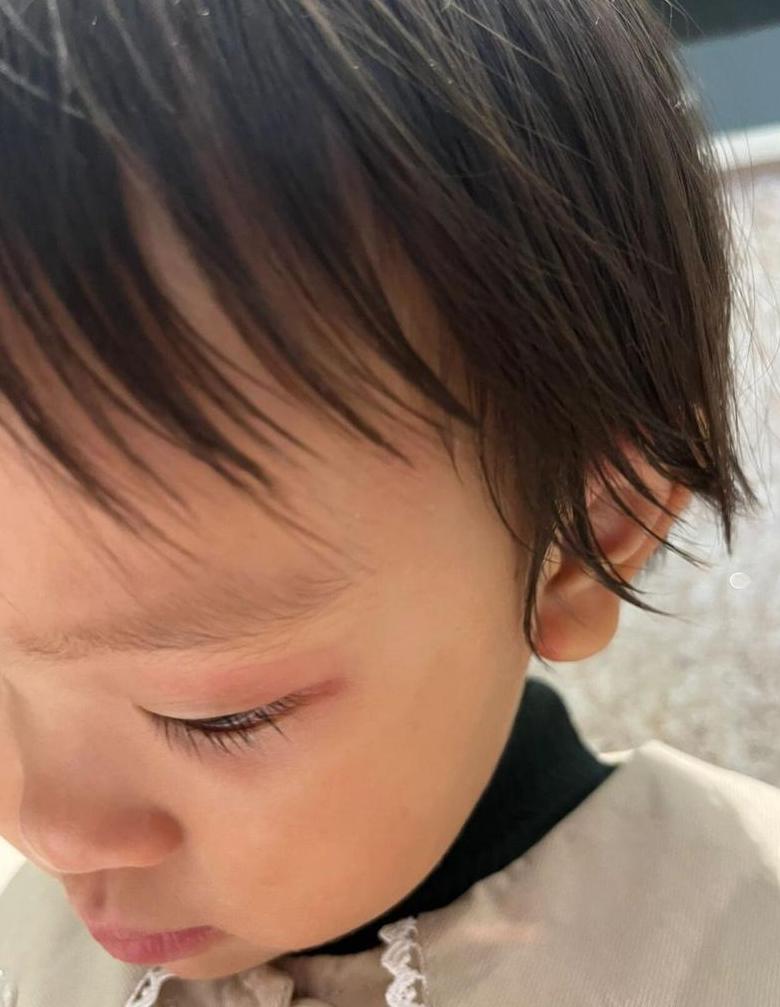 眼部湿疹治疗与预防攻略